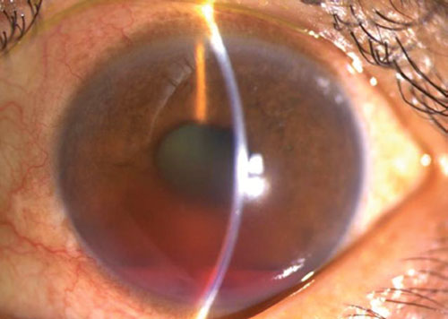 당뇨병으로 생긴 눈 속 신생 혈관이 녹내장 유발?