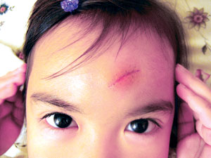 어린이 얼굴 상처 꿰맨 후 3~6개월 햇볕노출 피해야